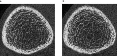 Longitudinal Evolution of Bone Microarchitecture and Bone Strength in Type 2 Diabetic Postmenopausal Women With and Without History of Fragility Fractures—A 5-Year Follow-Up Study Using High Resolution Peripheral Quantitative Computed Tomography